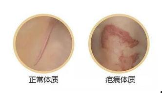 胳膊疤痕照片,一段不凡的康复历程